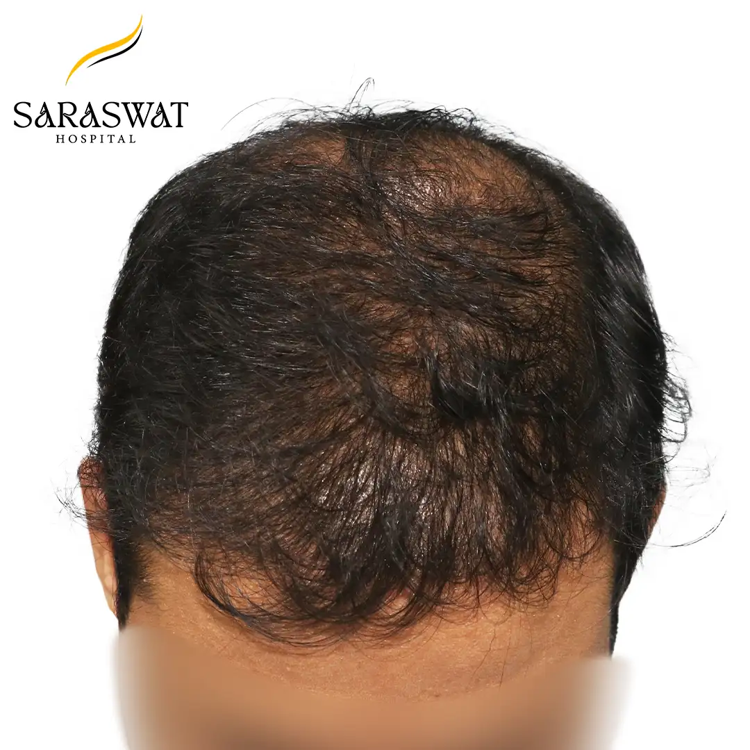 Top FUE Hair Transplant Result After Procedure