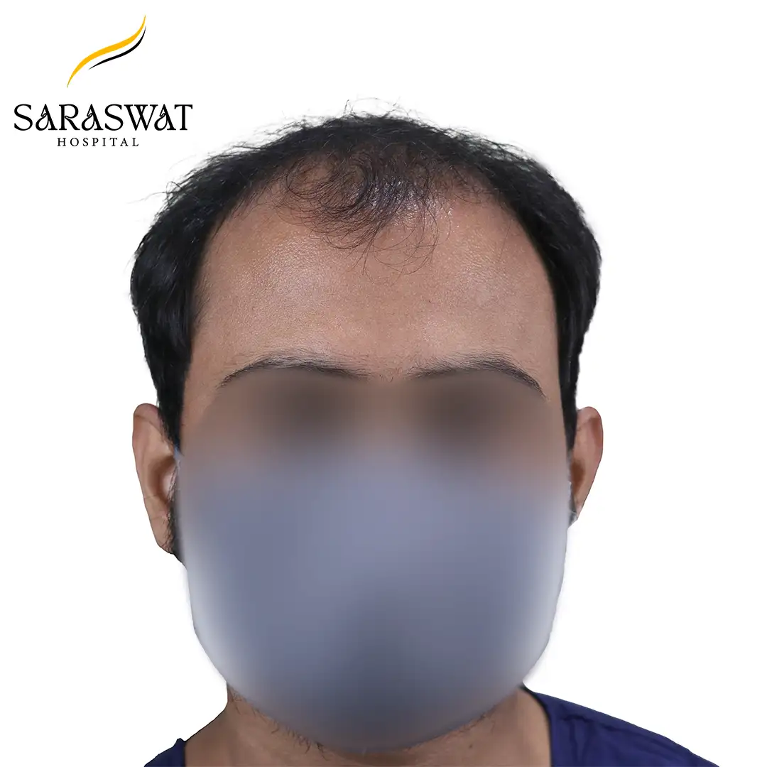 Front FUE Hair Transplant Result Before Procedure