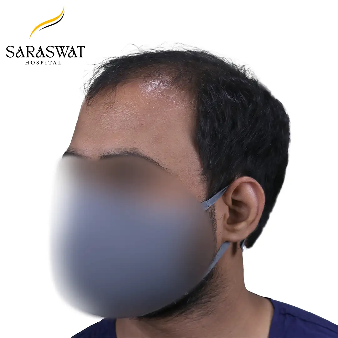 45 Degree Left FUE Hair Transplant Result Before Procedure