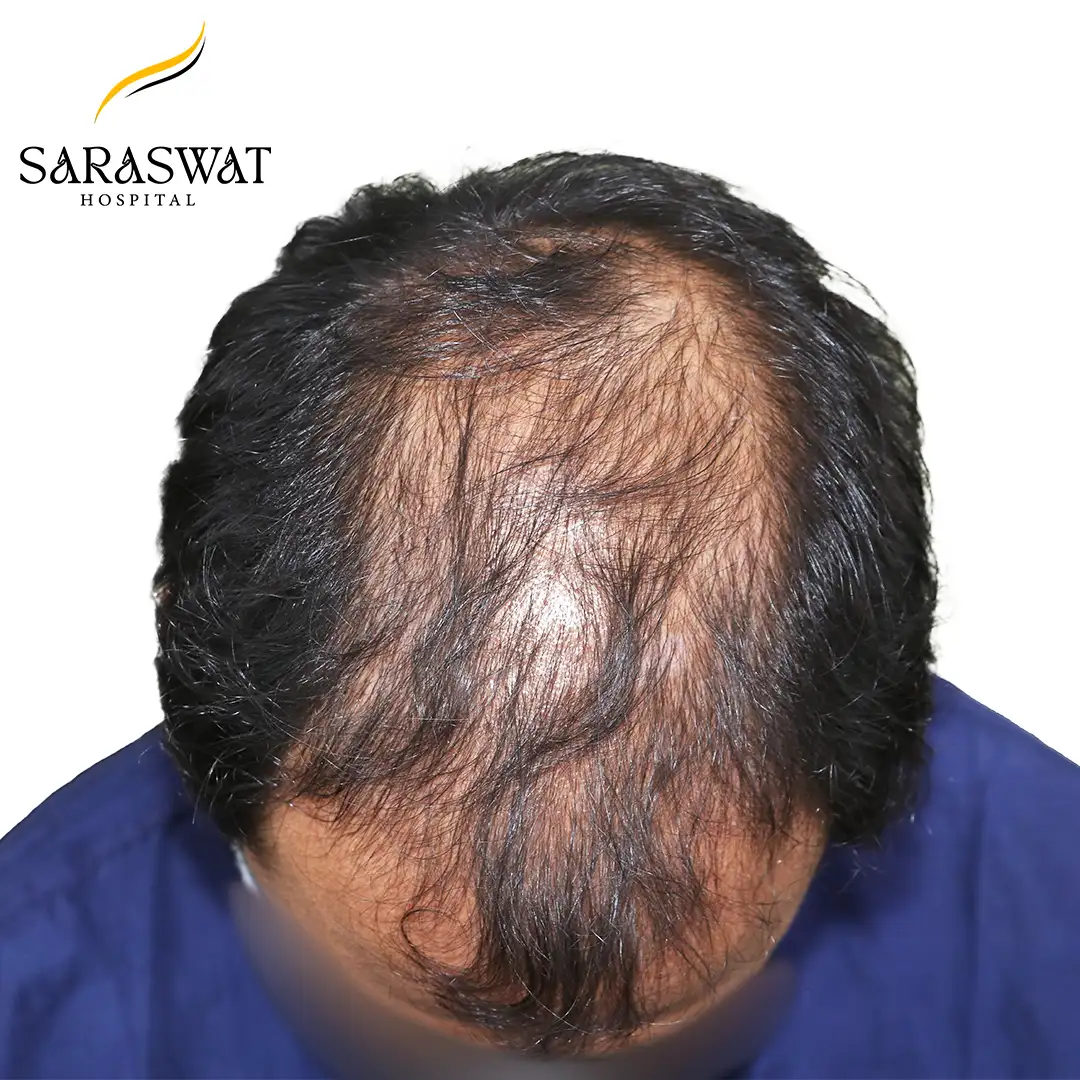 Top FUE Hair Transplant Result Before Procedure