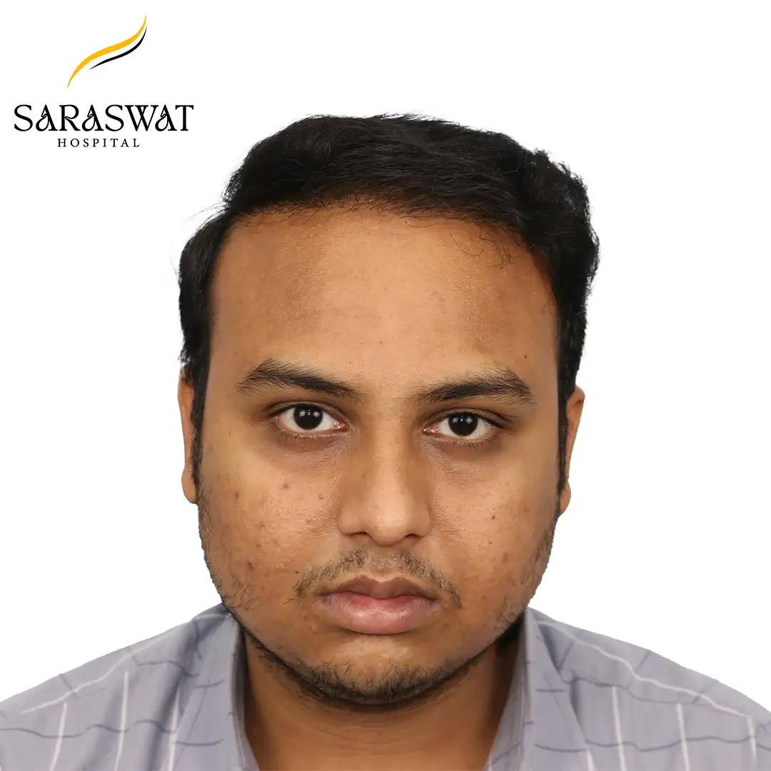 Front FUE Hair Transplant Result After Procedure