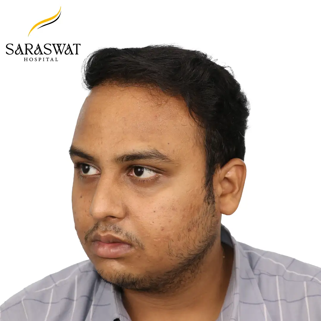 45 Degree Left FUE Hair Transplant Result After Procedure