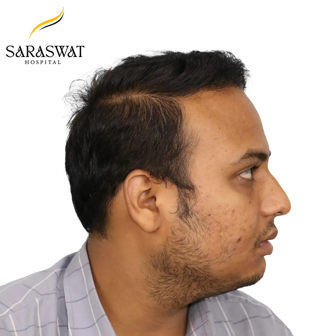 90 Degree Right FUE Hair Transplant Result After Procedure