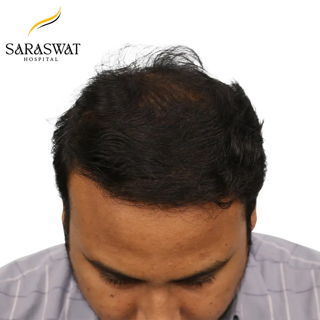Top FUE Hair Transplant Result After Procedure