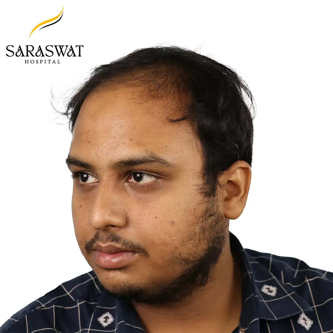 45 Degree Left FUE Hair Transplant Result Before Procedure