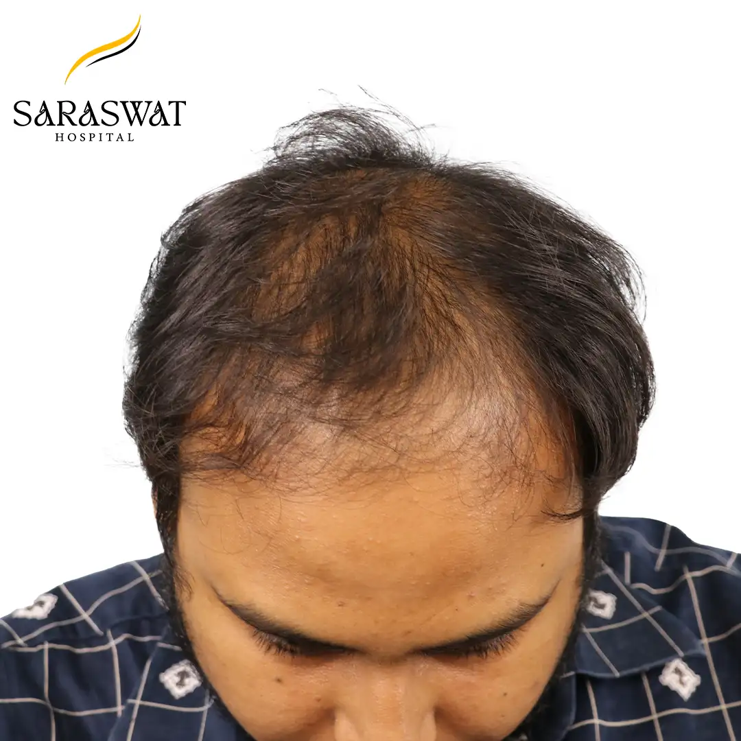Top FUE Hair Transplant Result Before Procedure