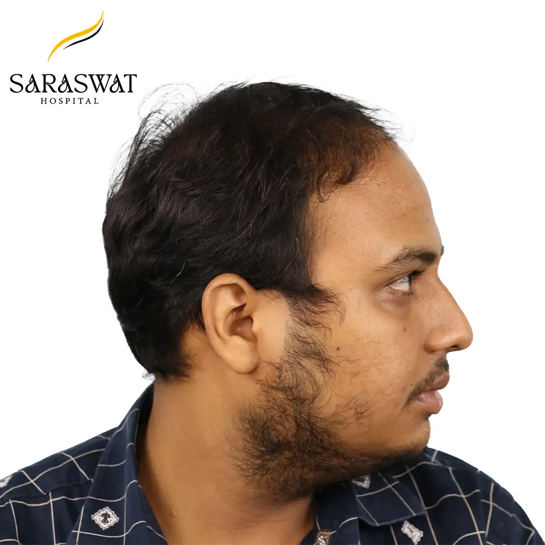 90 Degree Right FUE Hair Transplant Result Before Procedure