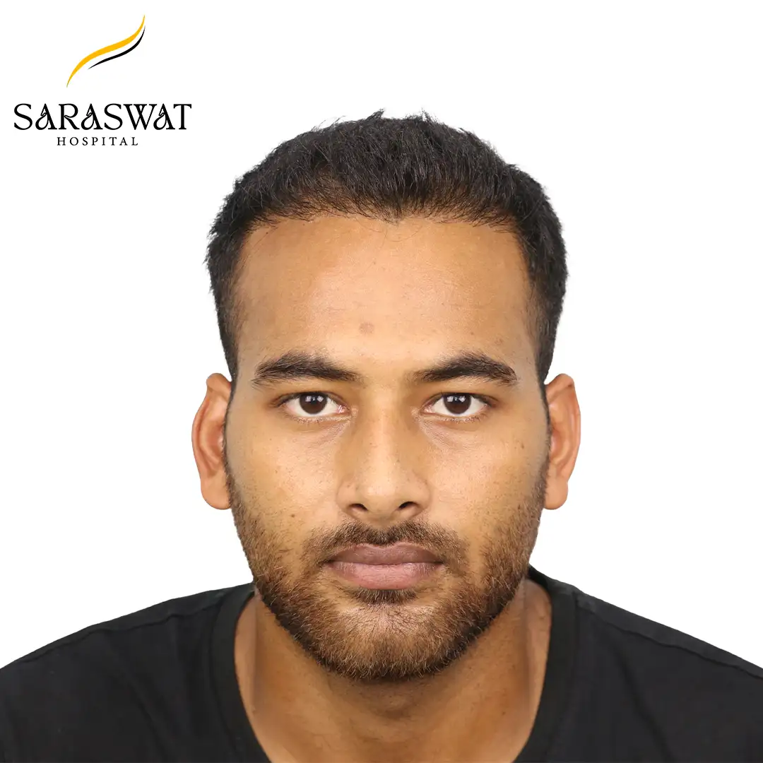 Front FUE Hair Transplant Result After Procedure
