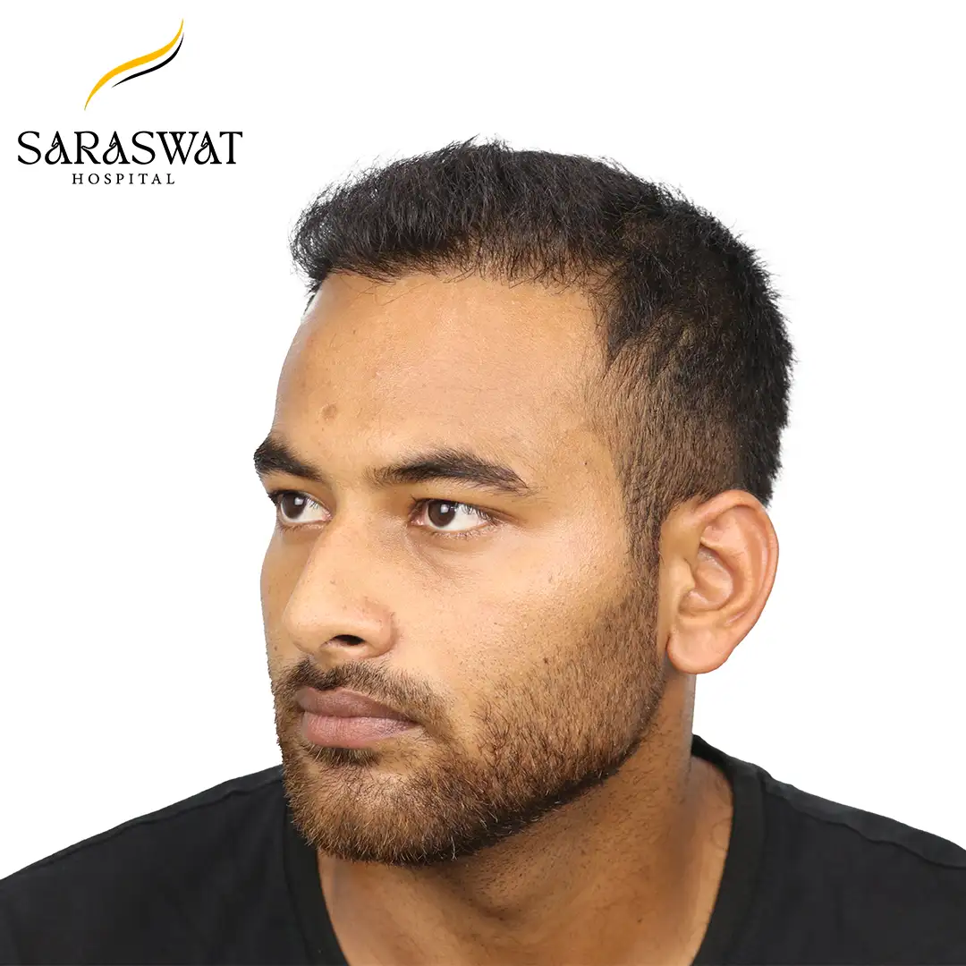 45 Degree Left FUE Hair Transplant Result After Procedure