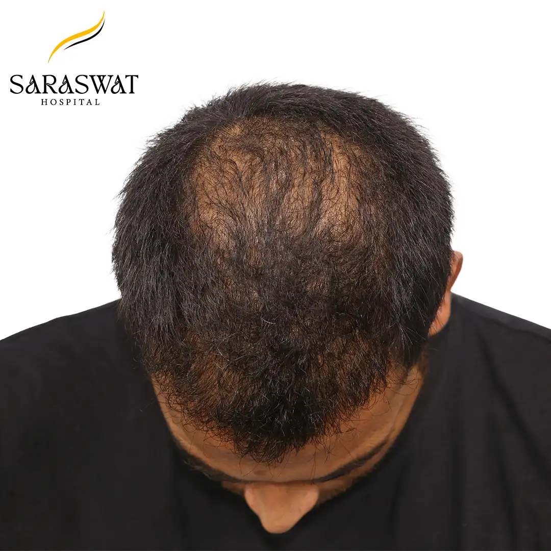 Top FUE Hair Transplant Result After Procedure