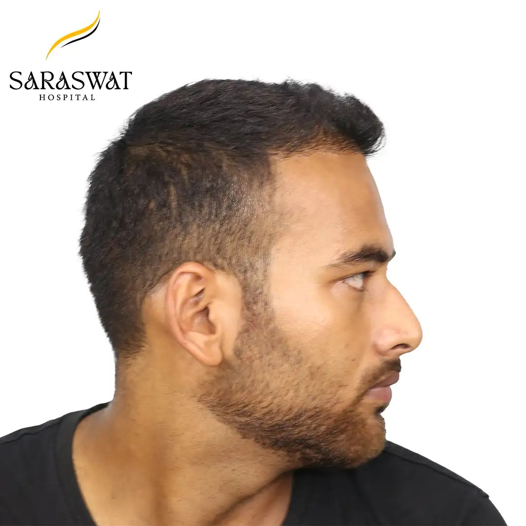 90 Degree Right FUE Hair Transplant Result After Procedure