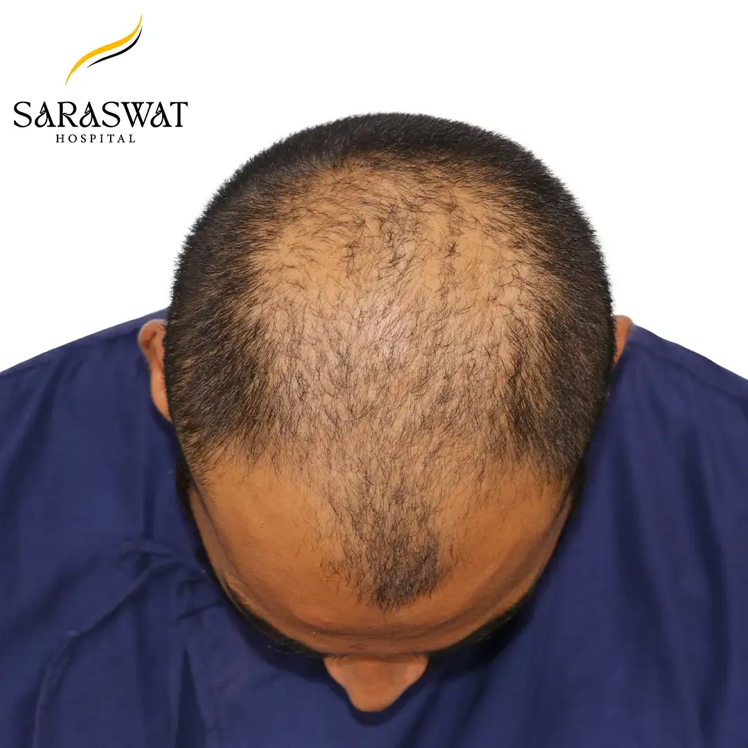Top FUE Hair Transplant Result Before Procedure