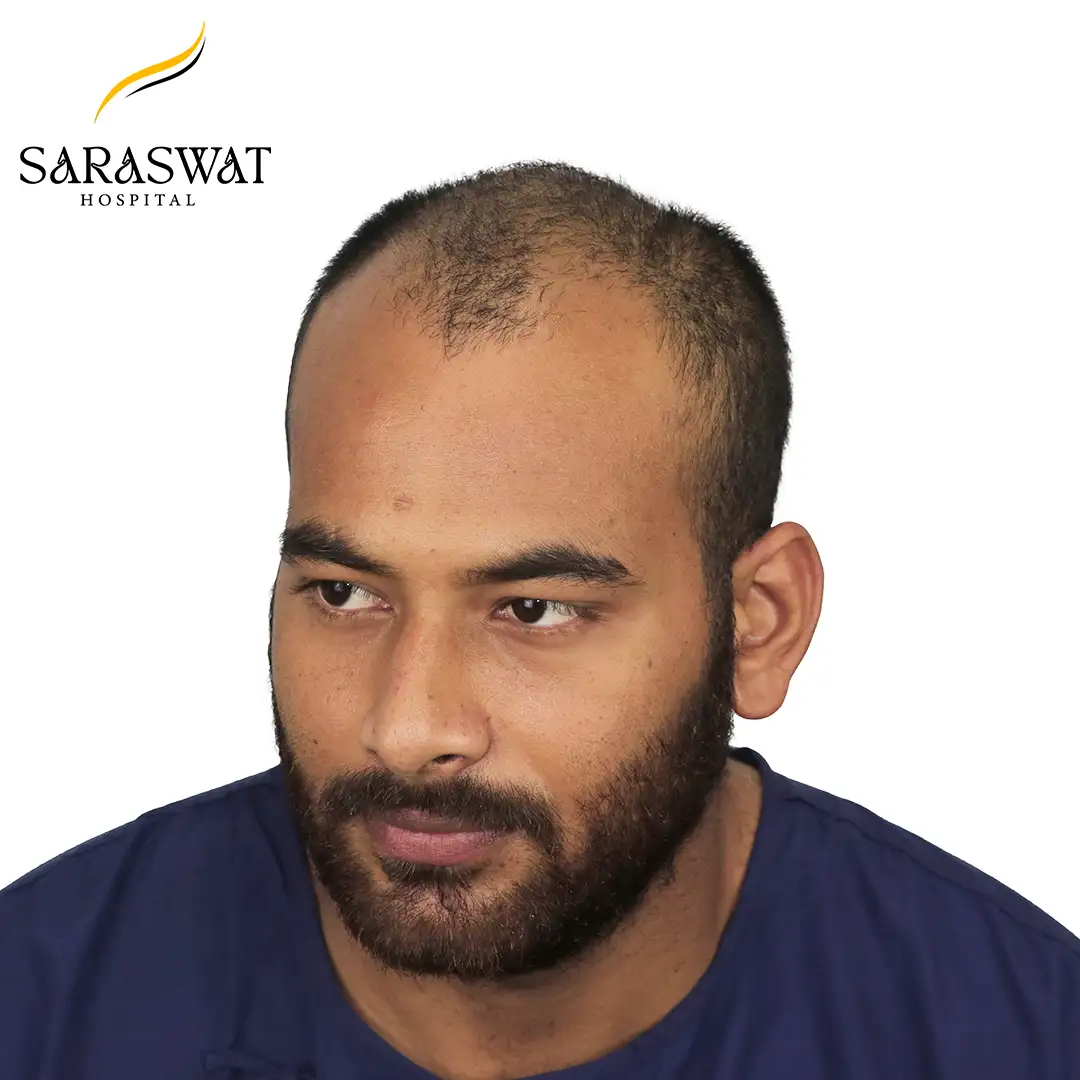 45 Degree Left FUE Hair Transplant Result Before Procedure
