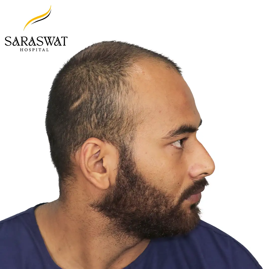 90 Degree Right FUE Hair Transplant Result Before Procedure