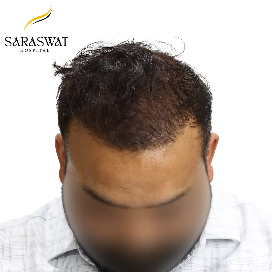 Top FUE Hair Transplant Result After Procedure