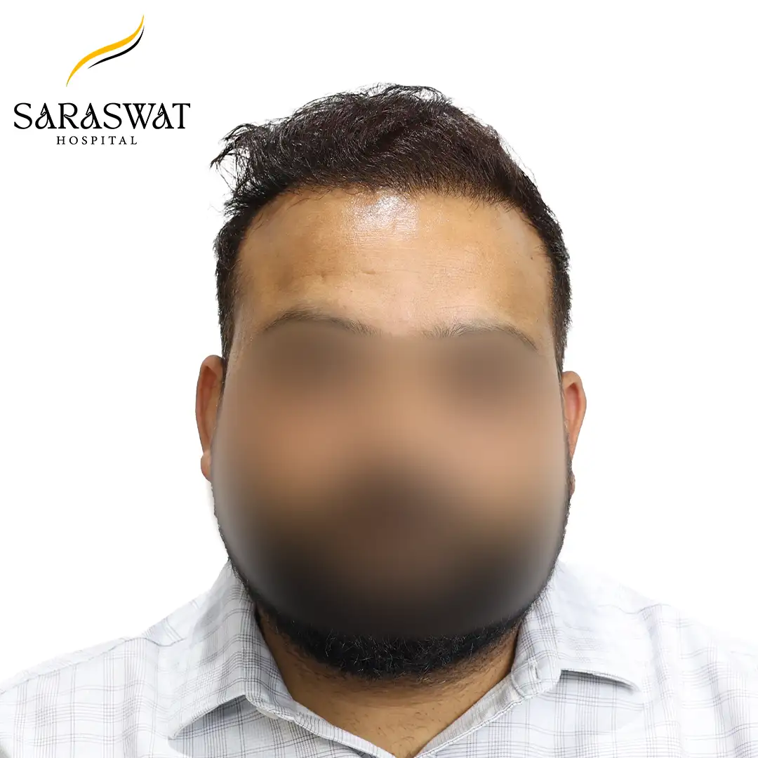 Hair Transplant Before After