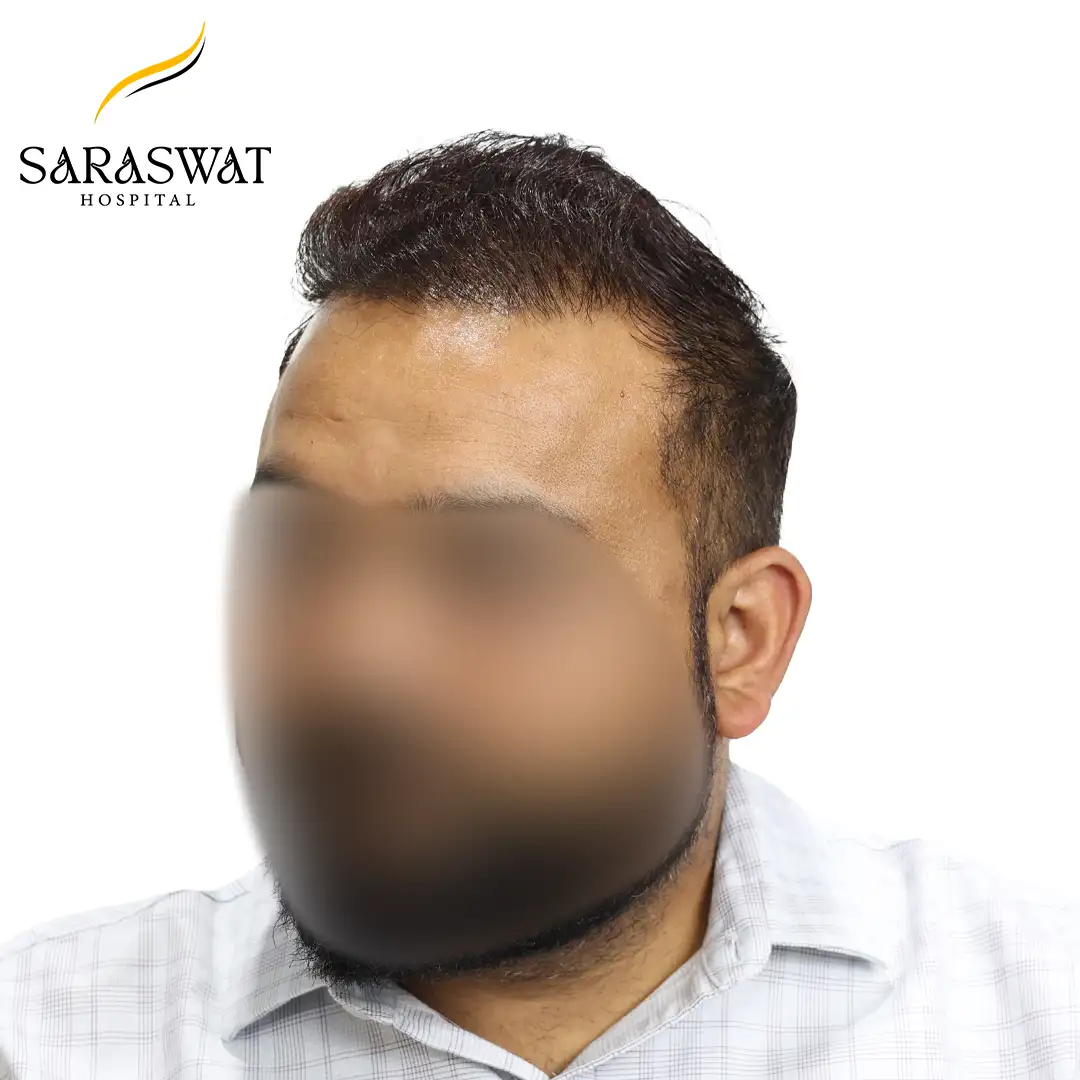 45 Degree Left FUE Hair Transplant Result After Procedure
