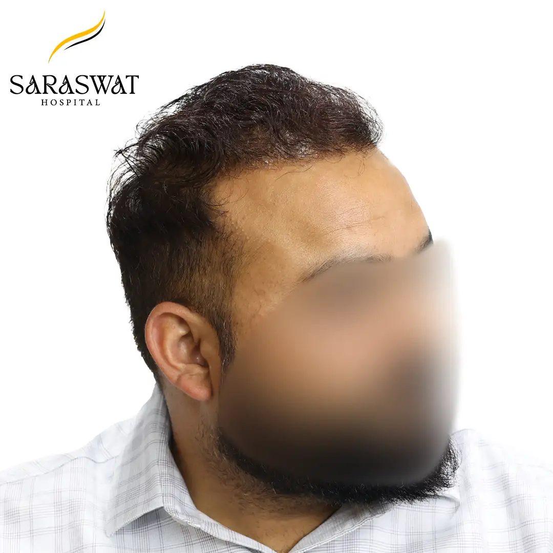 Hair Transplant Before and After Results