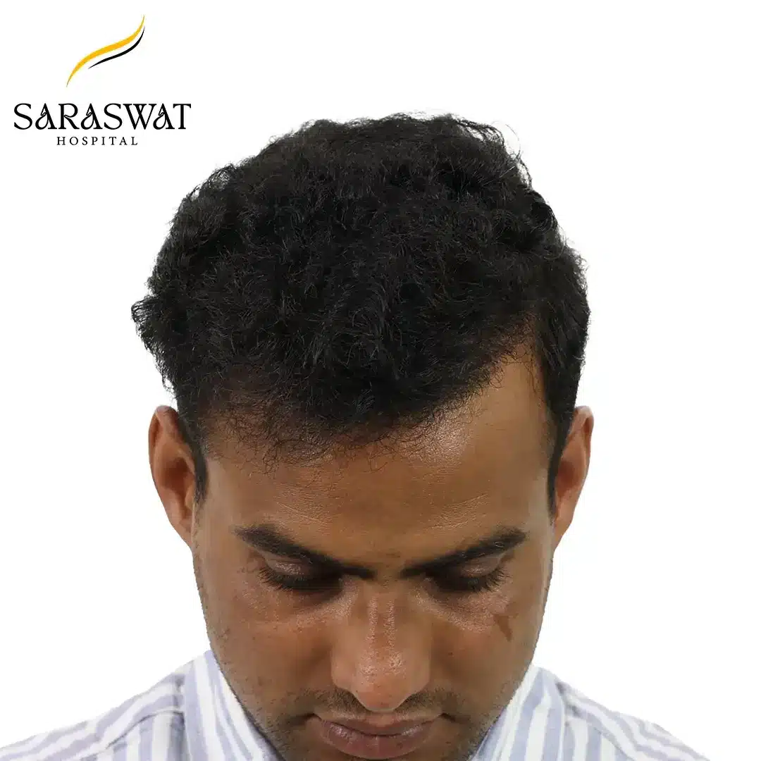 Hair Transplant Before and After