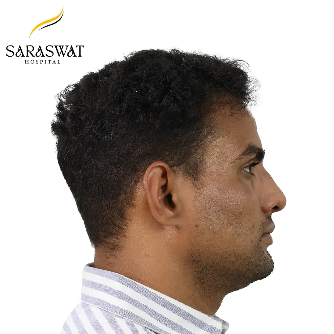 90 Degree Right FUE Hair Transplant Result After Procedure