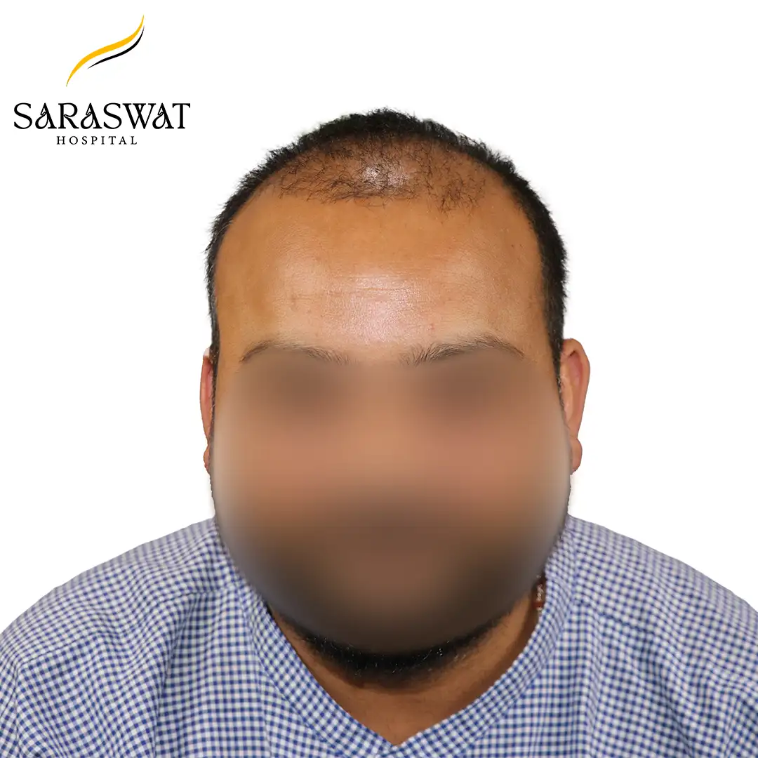 Hair Transplant Before After