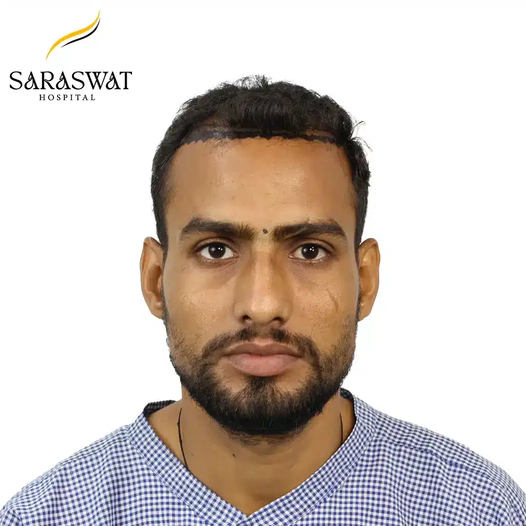 Hair Transplant Before and After