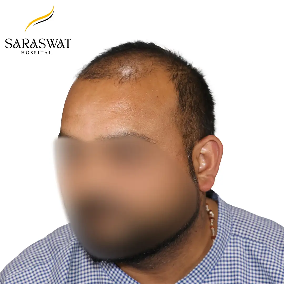 45 Degree Left FUE Hair Transplant Result Before Procedure