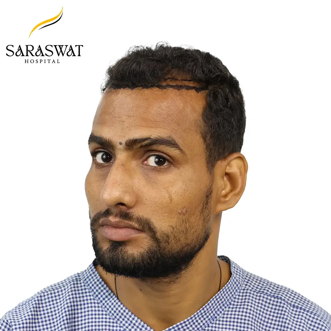 Hair Transplant Before and After