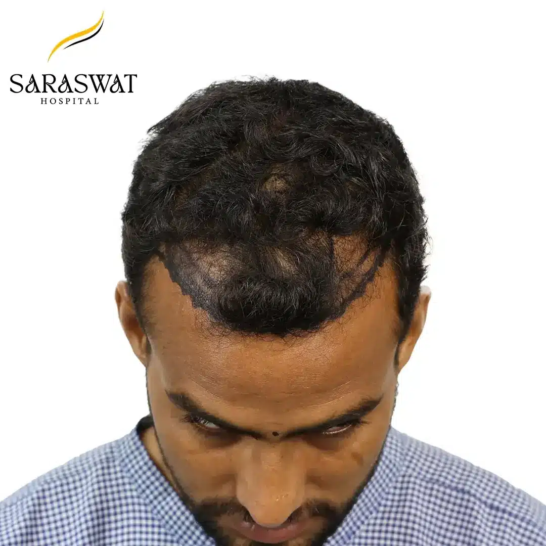 Hair Transplant Before and After