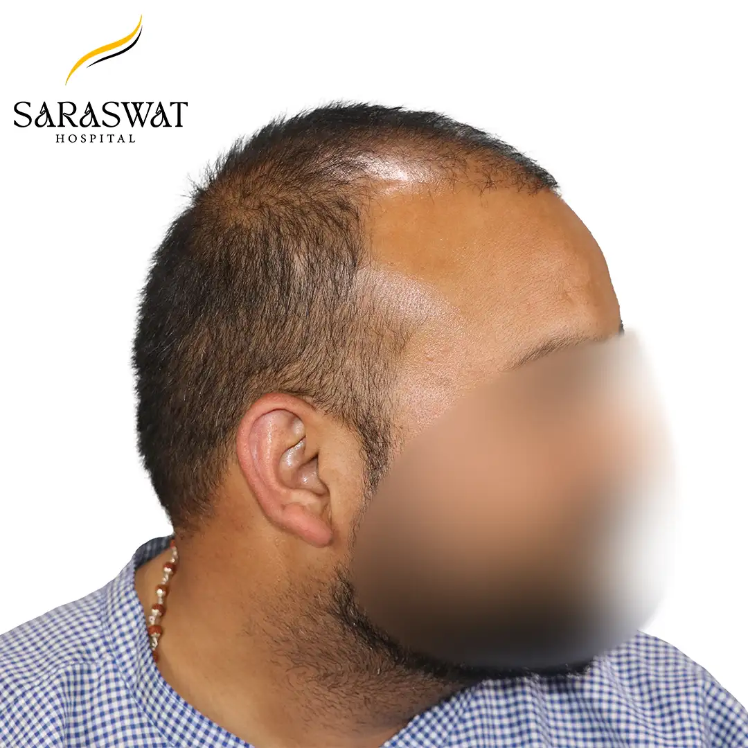 Hair Transplant Before and After Results