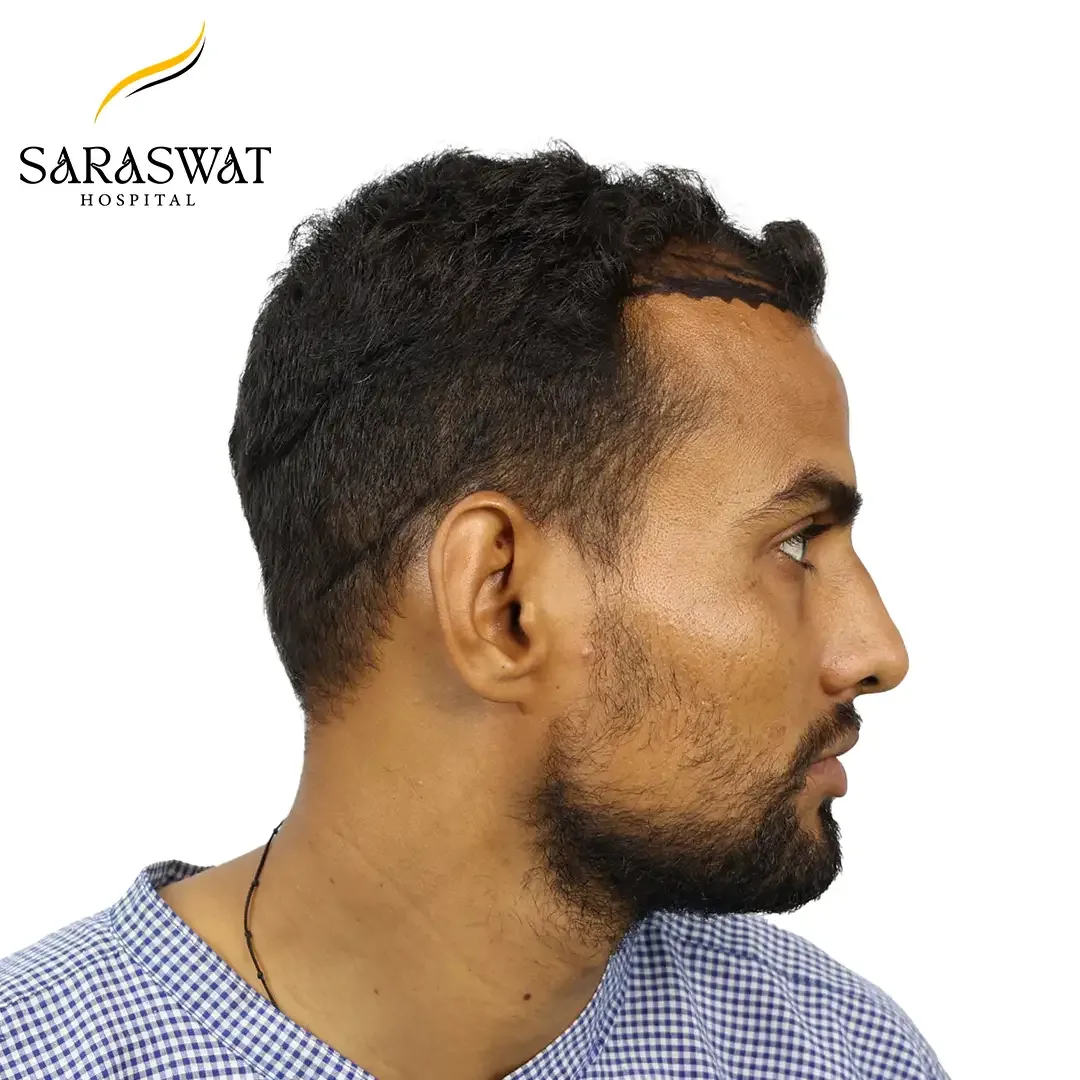 90 Degree Right FUE Hair Transplant Result Before Procedure