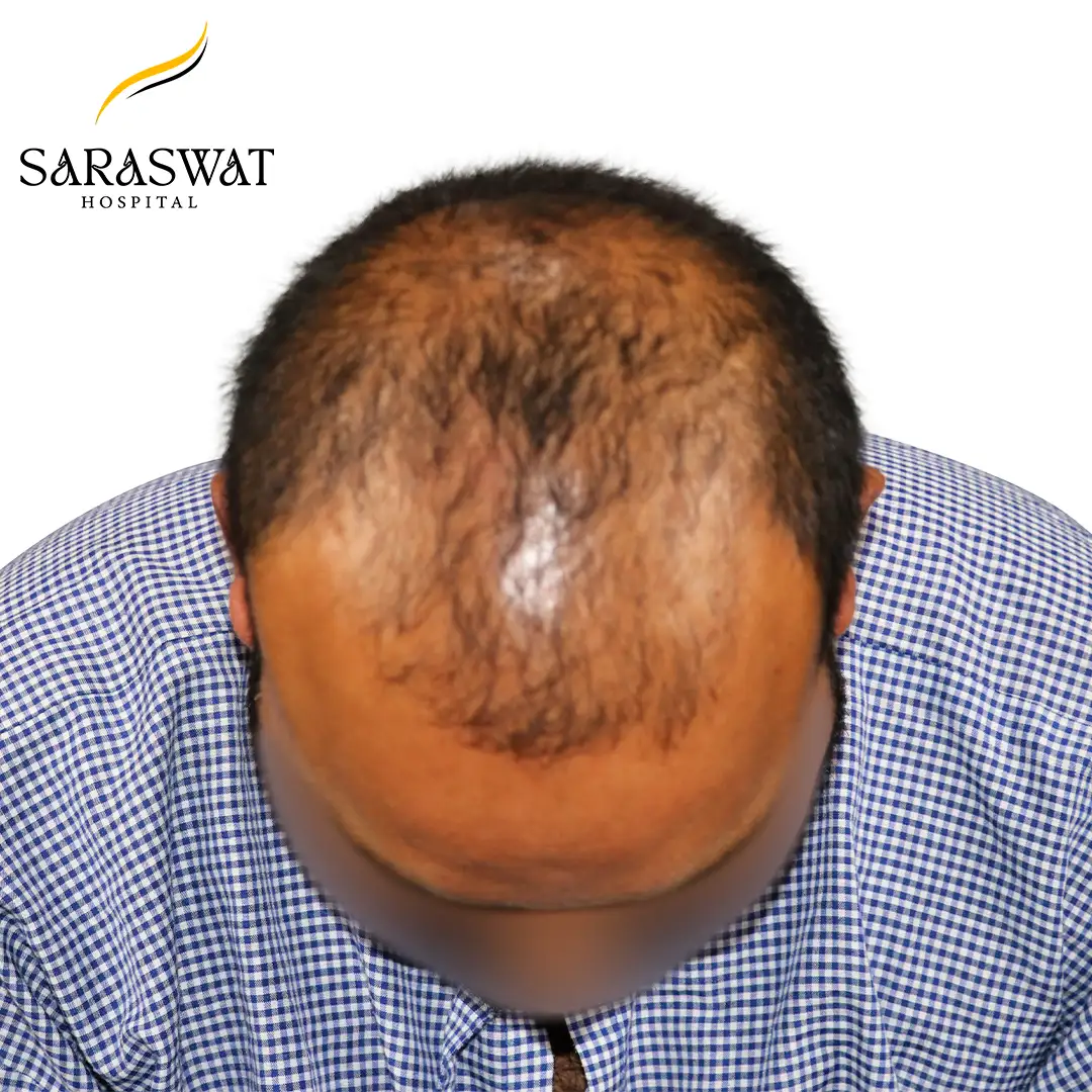 Top FUE Hair Transplant Result Before Procedure