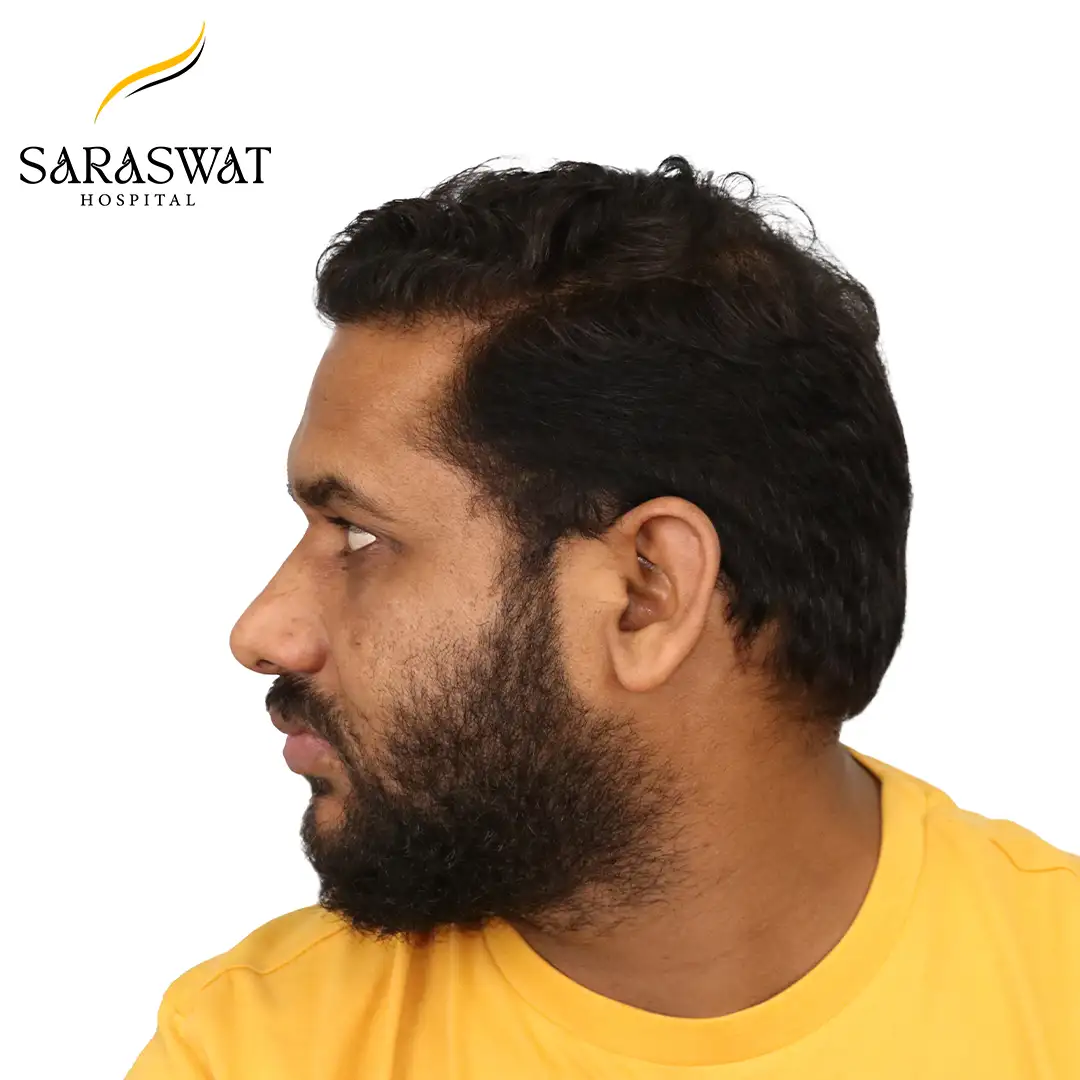 90 Degree Left FUE Hair Transplant Result After Procedure