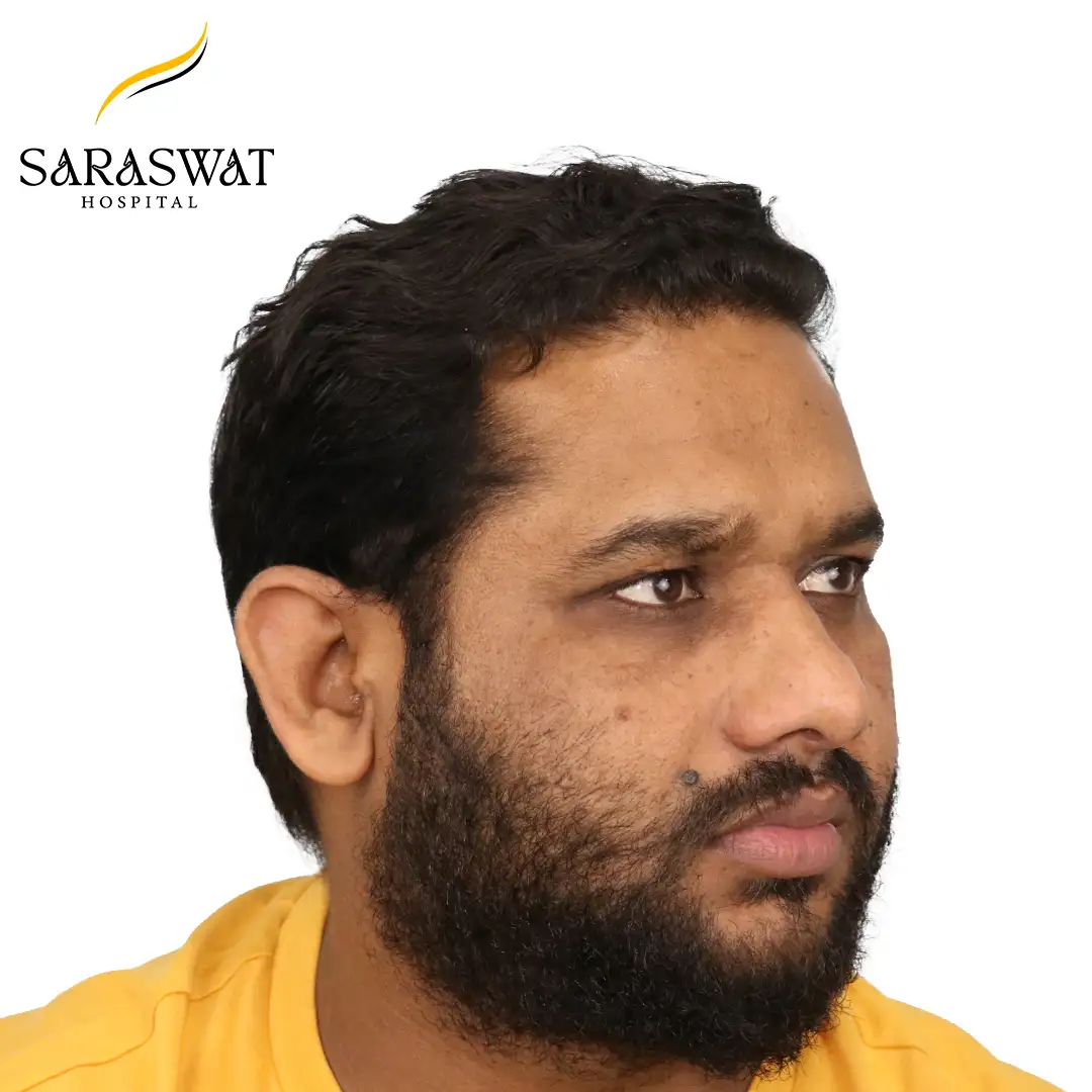 45 Degree Right FUE Hair Transplant Result After Procedure