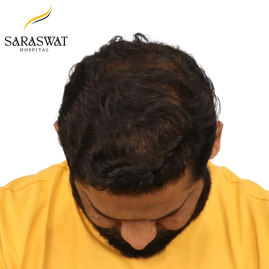 Top FUE Hair Transplant Result After Procedure