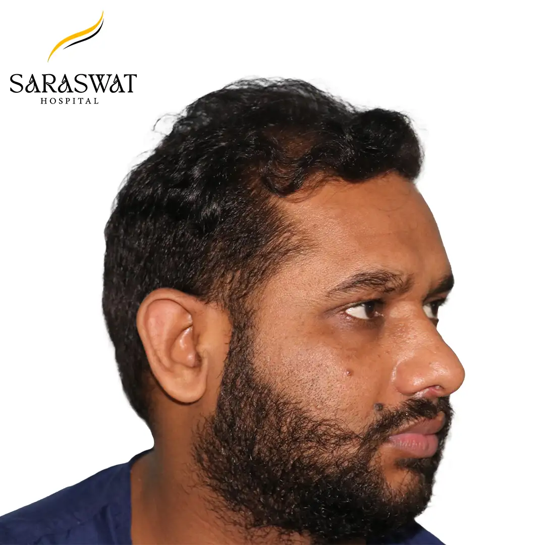 45 Degree Right FUE Hair Transplant Result Before Procedure