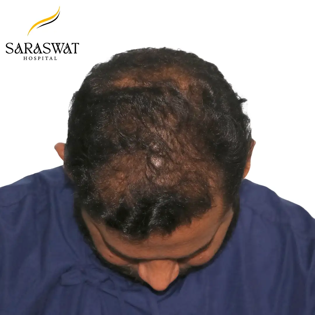 Top FUE Hair Transplant Result Before Procedure