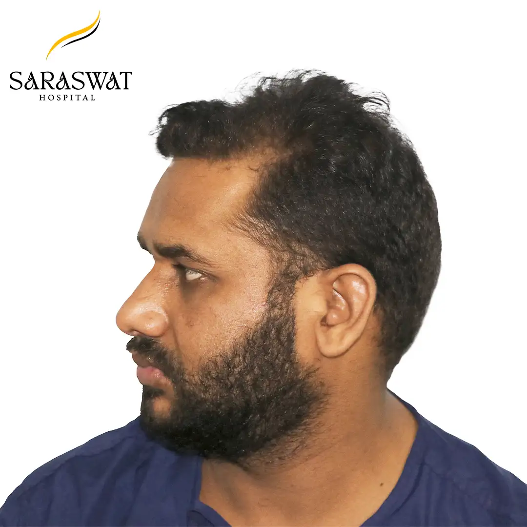 90 Degree Left FUE Hair Transplant Result Before Procedure