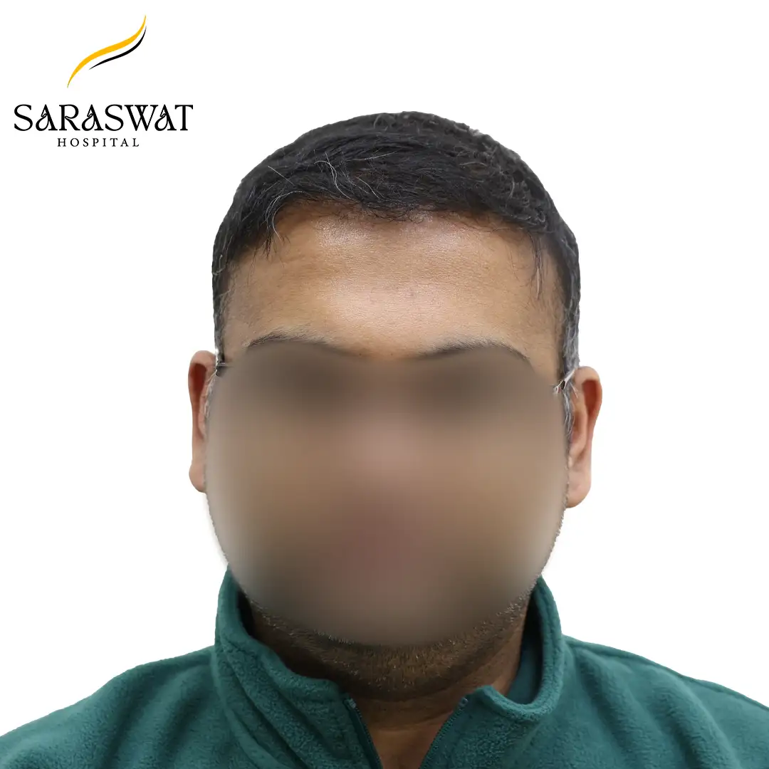 Front FUE Hair Transplant Result After Procedure