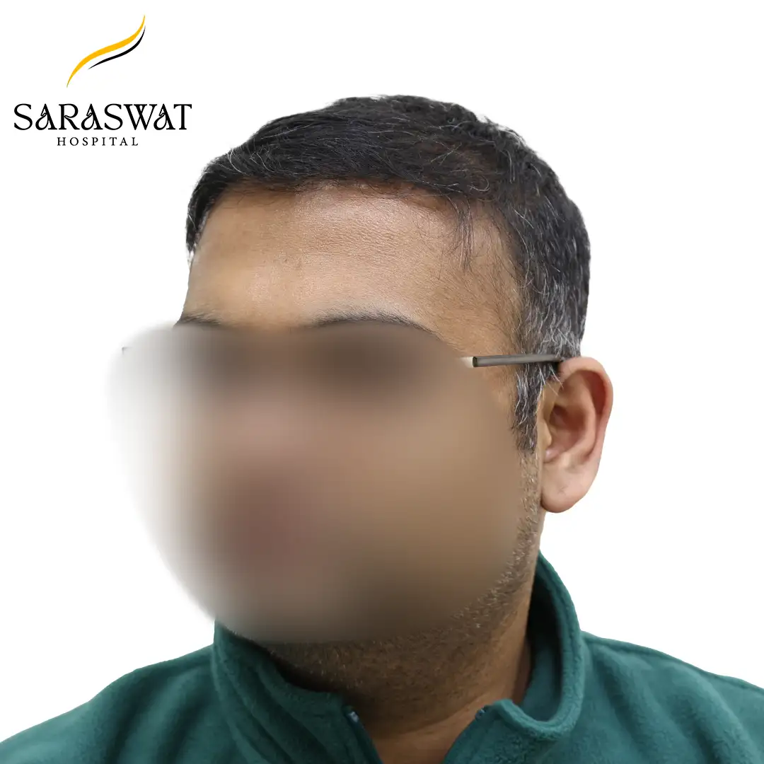 45 Degree Left FUE Hair Transplant Result After Procedure