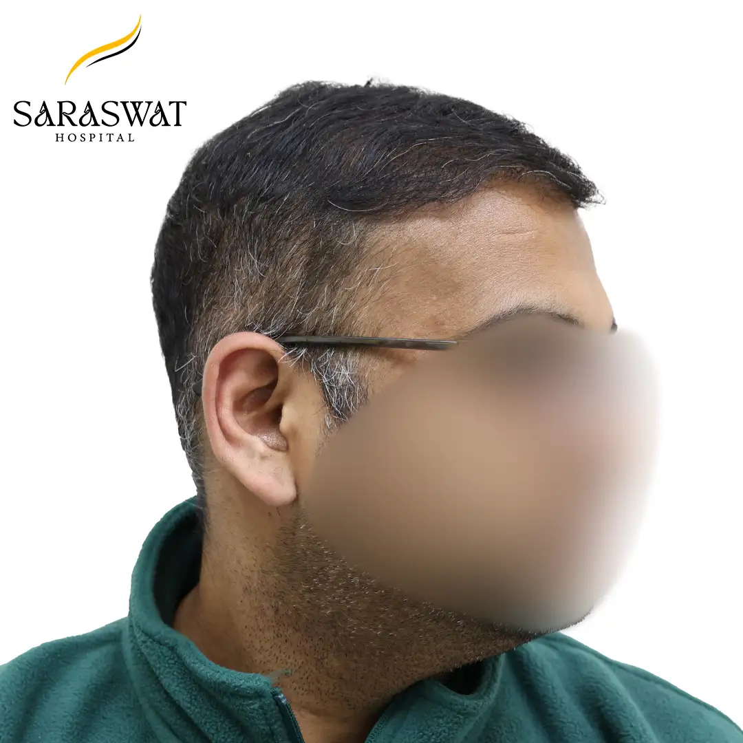 90 Degree Right FUE Hair Transplant Result After Procedure