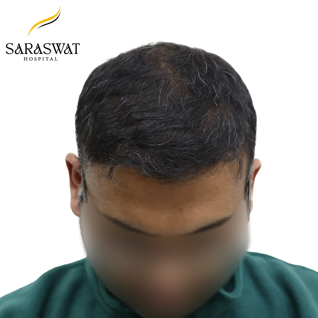 Top FUE Hair Transplant Result After Procedure