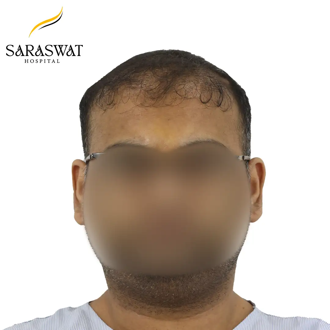 Front FUE Hair Transplant Result Before Procedure