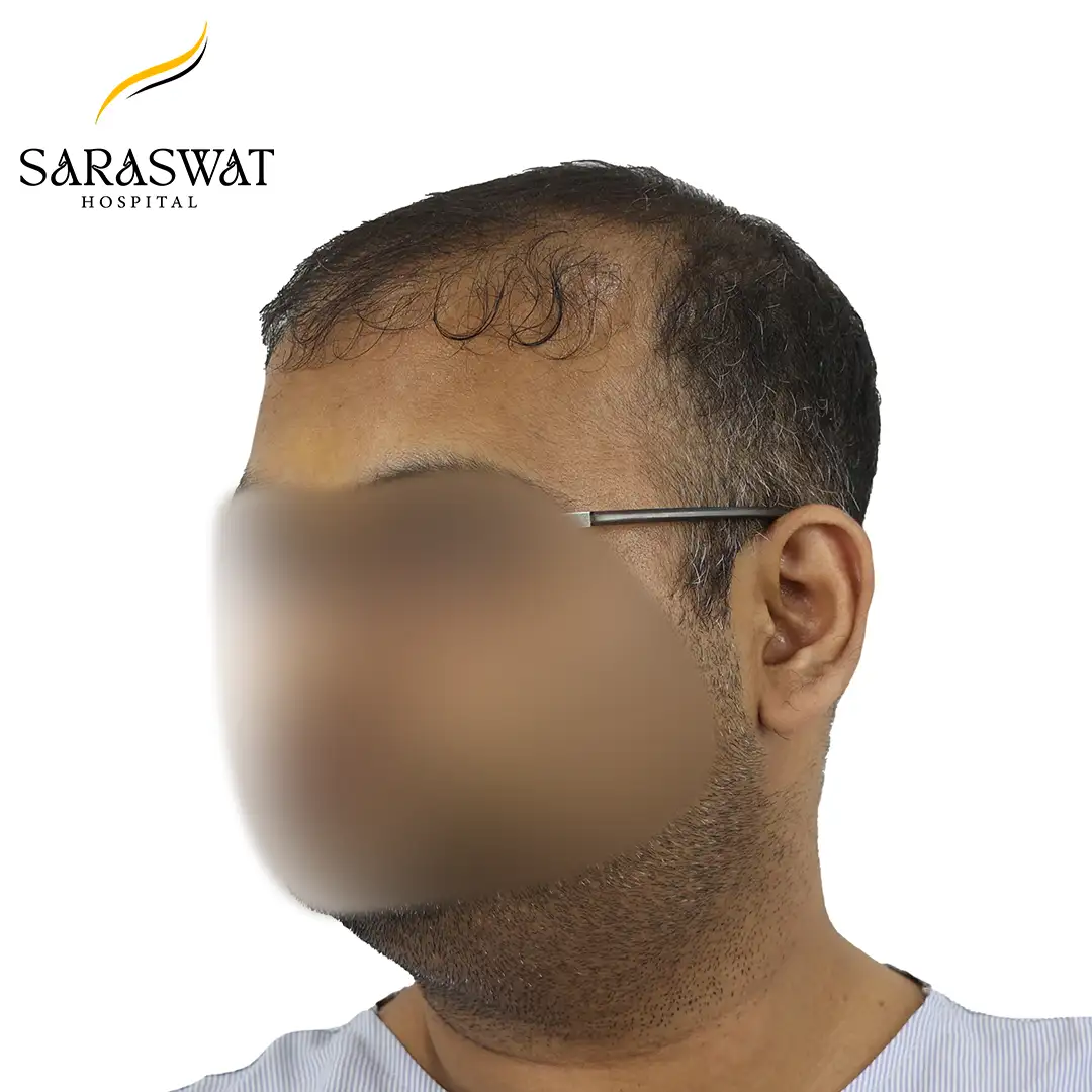 45 Degree Left FUE Hair Transplant Result Before Procedure