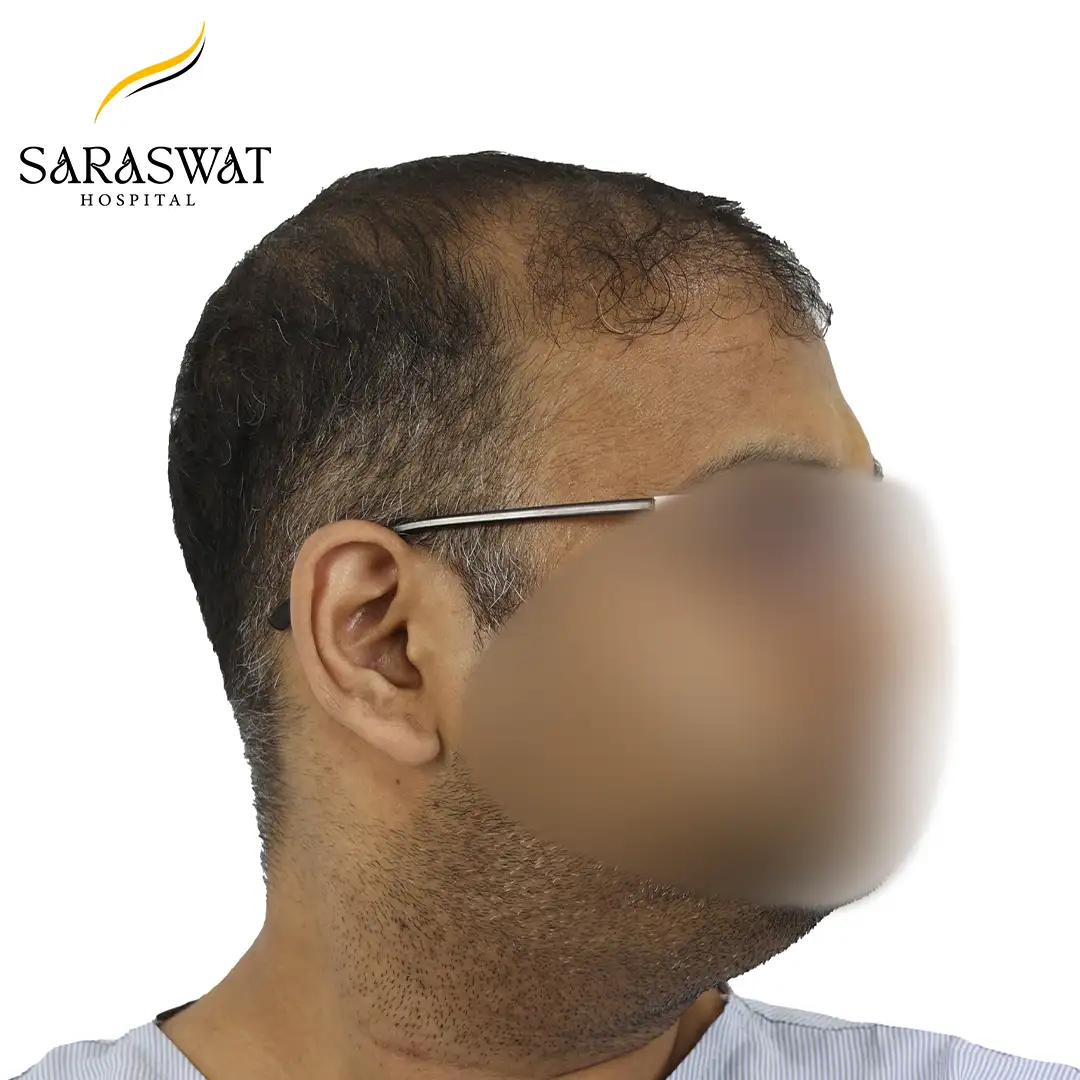 90 Degree Right FUE Hair Transplant Result Before Procedure