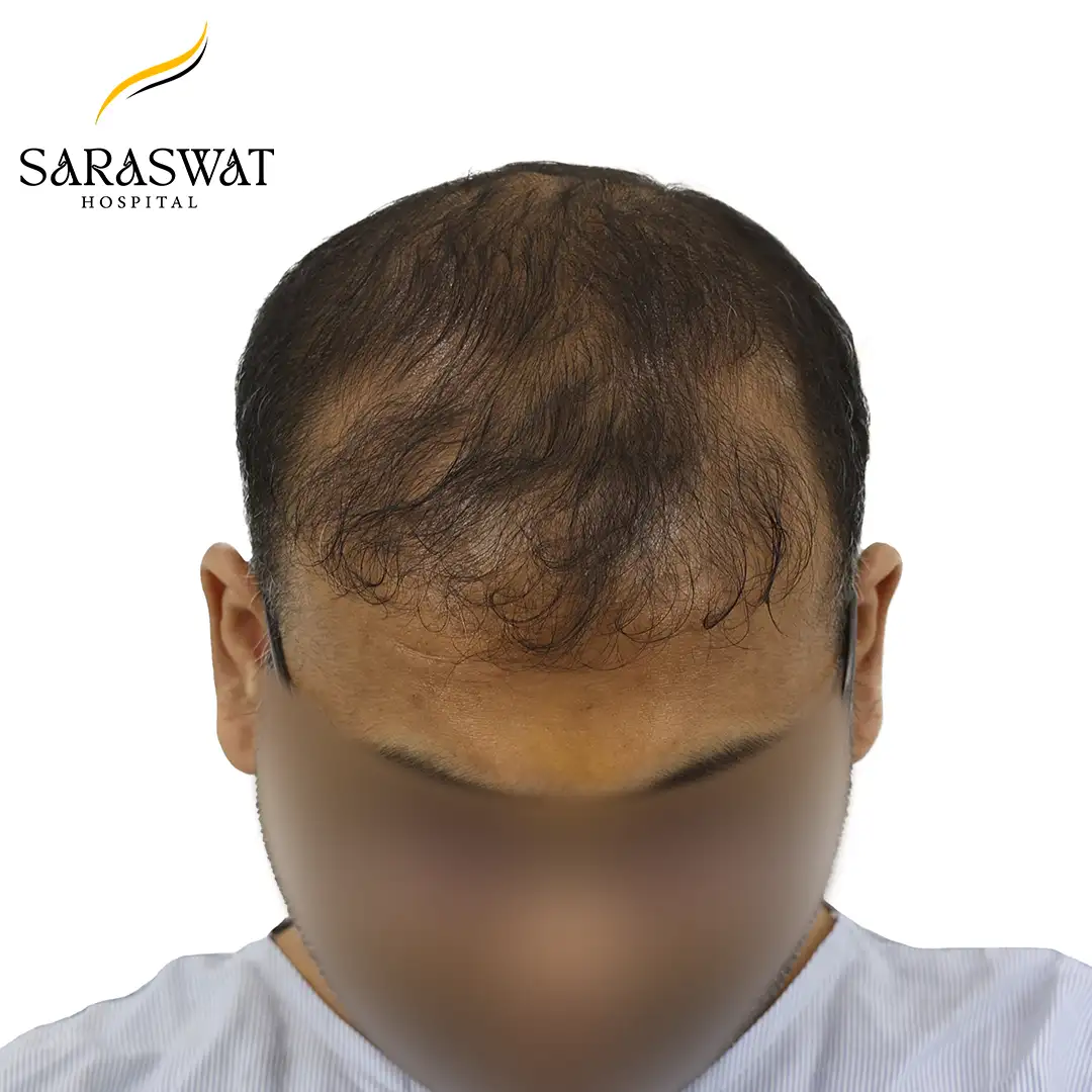 Top FUE Hair Transplant Result Before Procedure
