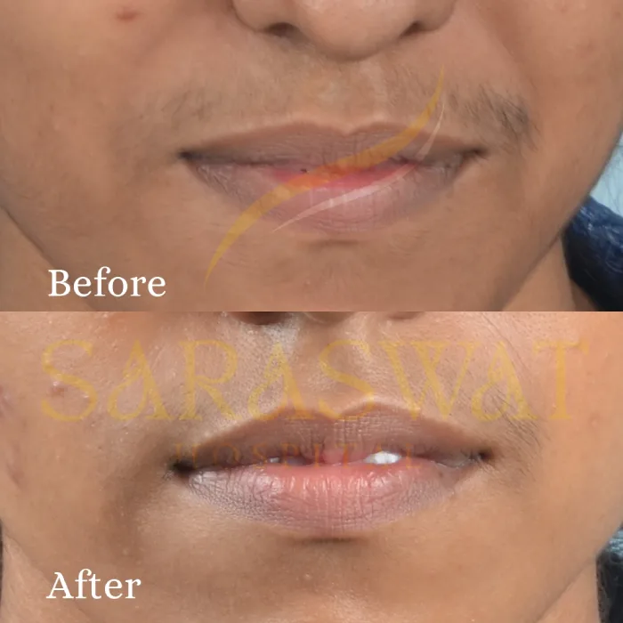 Upper lip hair removal
