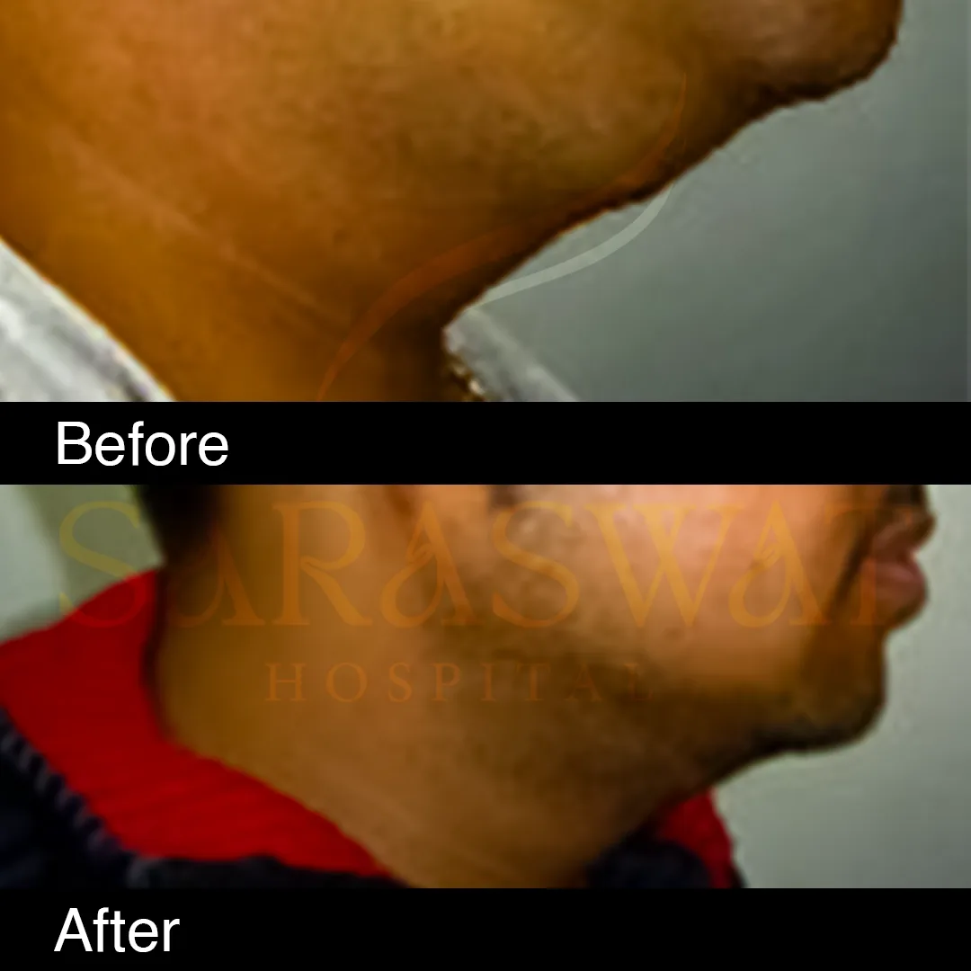 Liposuction Before and After