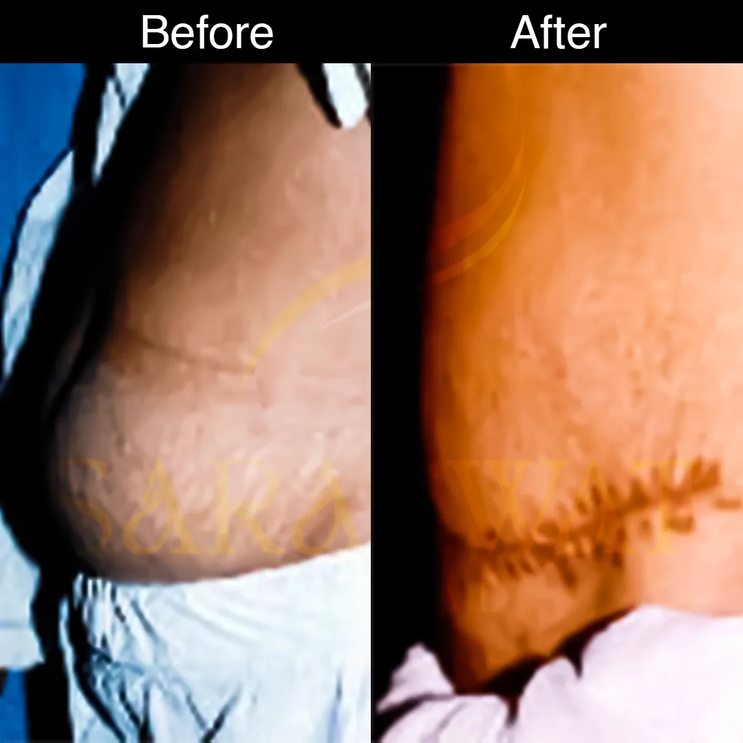 Liposuction Before and After
