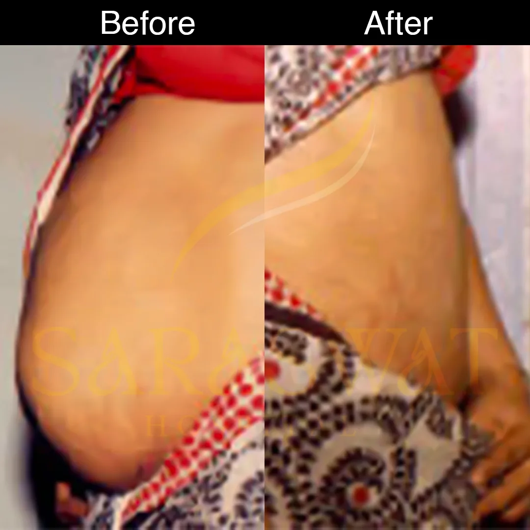 Liposuction Surgery in India